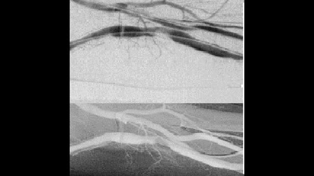 INTERVENTIONAL NEPHROLOGY   INFOGRAPHICS