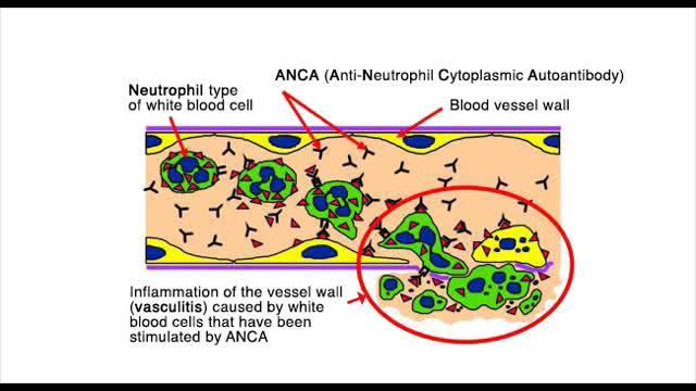 ANCA VASCULITIS IN KIDNEY - CASE CONFERENCE
