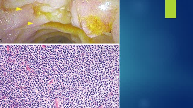 35 year old lady post renal transplant with diarrhea, weight loss and anasarca.