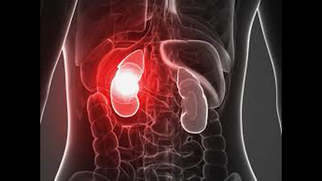 ACUTE KIDNEY INJURY  INFOGRAPHICS