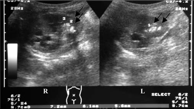 Multiple-bilateral-renal-calculi and medullary-nephrocalcinosis