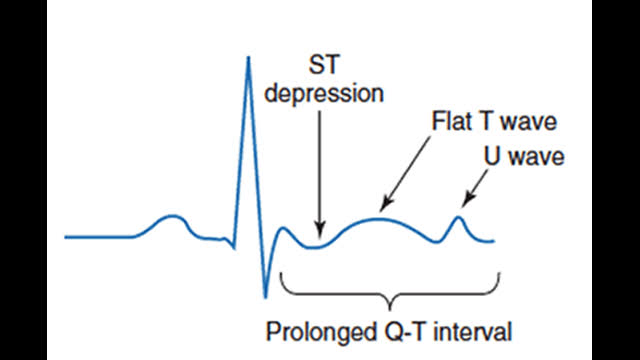 Hypokalemia case conference