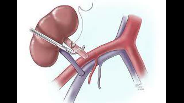 RENAL TRANSPLANT  INFOGRAPHICS