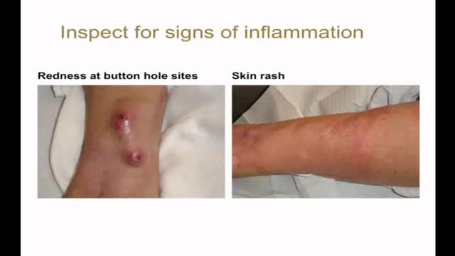 10-minute Rounds:  Physical Examination of the Arteriovenous Fistula