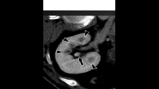 Diabetes patient with AKI, right flank pain and gross hematuria. 