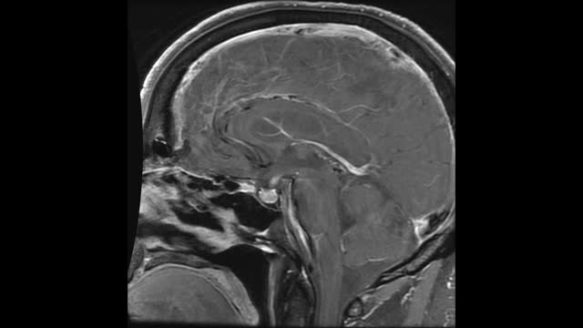 55-year-old male with Hyponatremia & melanoma
