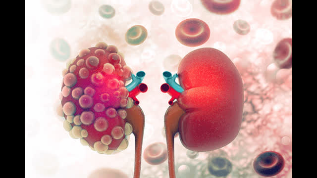 RENAL CA/CYST INFOGRAPHICS