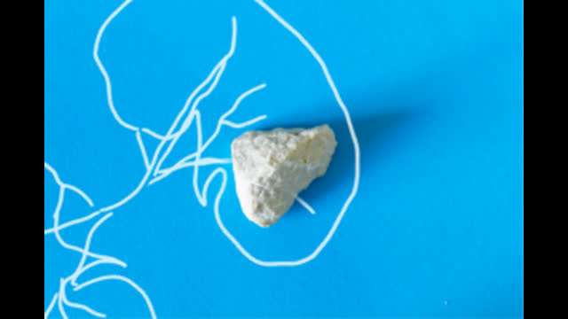 NEPHROLITHIASIS  INFOGRAPHICS