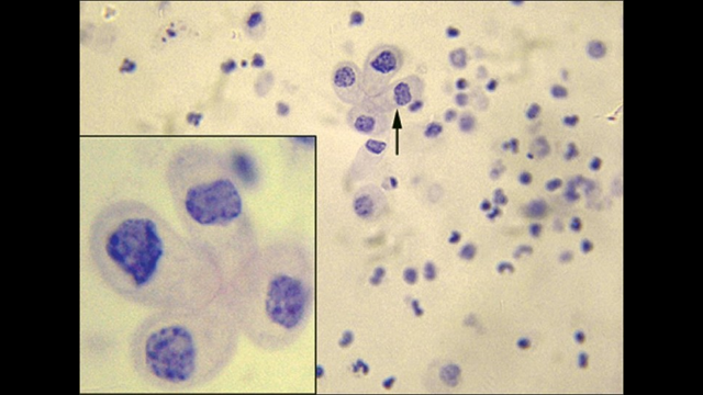 hematuria and AKI Post transplant