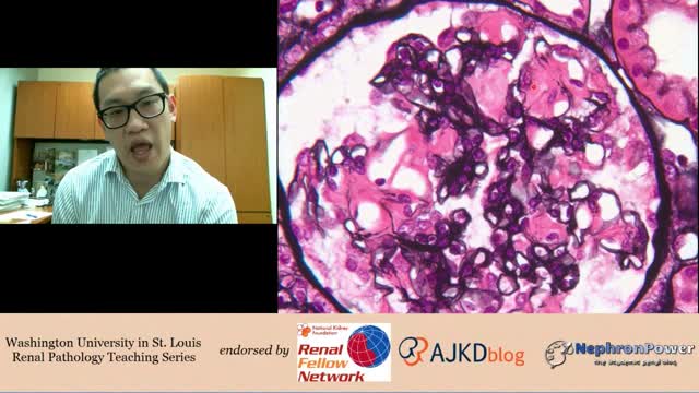 Web Episode #006 - Renal Pathology Teaching Series (Renal Amyloidosis)