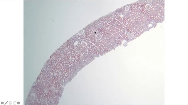 IgA Nephropathy - Fellow's Level Overview of Basic Pathophysiology and Treatment