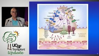 Recurrent FSGS: Whatâ€™s New? - UCSF Kidney Transplant Program - Update in Transplantation 2013