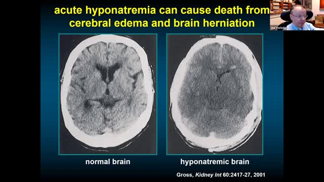 SIADH and Diabetes Insipidus