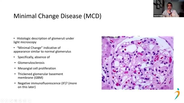 MCD vs. FSGS: Breakdown of Diagnostics and Clinical Course