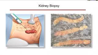 NephCure U: Membranous Nephropathy and You