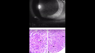 45 year old male with eye pain, blurred vision, renal insufficiency and proteinuria
