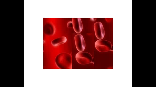 Recurrent hematuria and left flank pain In a 25-year-old lady