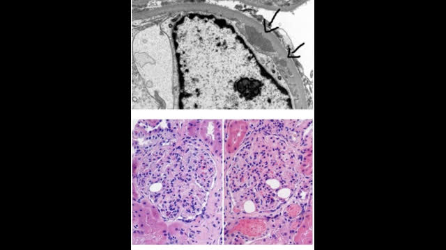 22 year old lady with muscle weakness, renal insufficiency and proteinuria