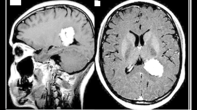 78 year old male with metastatic myeloma presenting with AMS , polyuria and neutropenic fever.