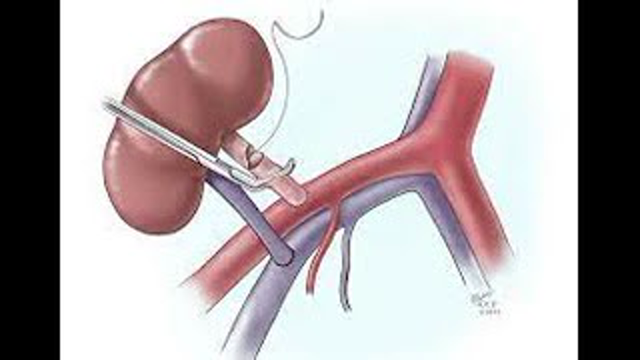 Transplant patient with AKI & Kidney stone