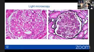 Dr. Priya Alexander - Recent advance in the diagnosis of fibrillary glomerulonephritis.