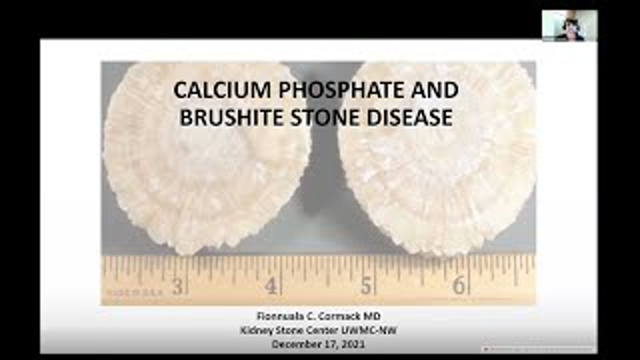 Fionnulal Cormack, MD - Brushite Stones