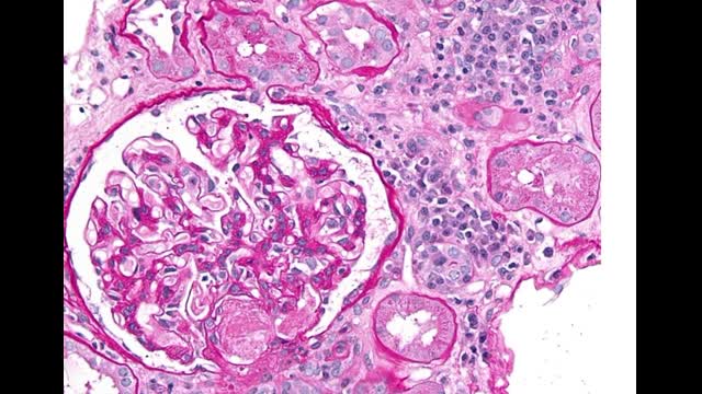 77-year-old man with a  type 2 DM presents with worsening renal function and proteinuria