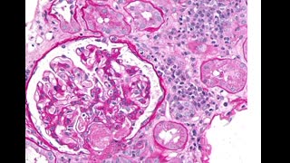 77-year-old man with a  type 2 DM presents with worsening renal function and proteinuria