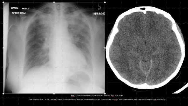 55-year-old lady with ASA poisoning, dyspnea and altered mental status.