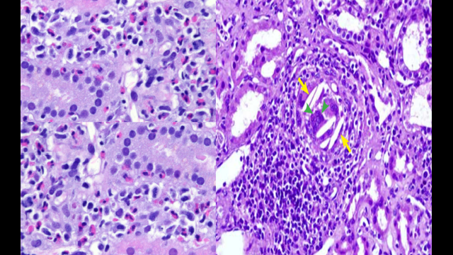 77-year-old male with HTN & recent TIA has AKI & hyperkalemia