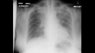 38 year old athelete with hyponatremia, Chest tightness, SOB and cough. 